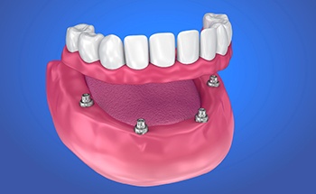 Digital model of All-On-4 dental implants.