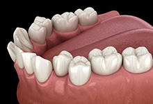 Illustration of crooked teeth