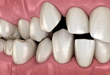 Illustration of spaced-out teeth