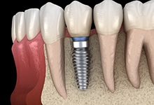 dental implant post in the jawbone 