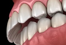 Illustration of overbite