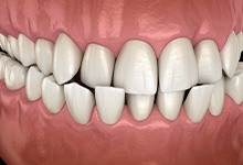 Illustration of a crossbite