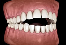 Illustration of an open bite