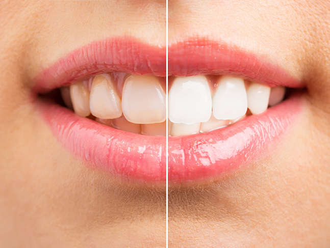 Close up of a smile before and after teeth whitening