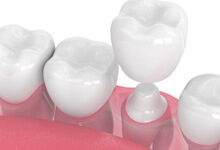 a 3D depiction of dental crowns