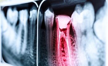 X-ray of dental emergency in Stone Oak