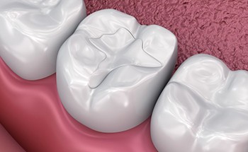 diagram of tooth-colored filling 