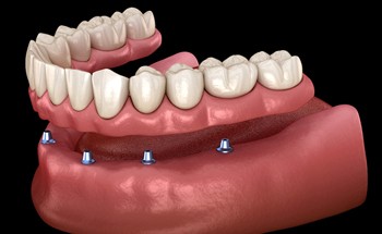 bottom row implant retained denture