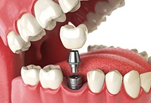 3D model of an implant, abutment, crown, and the rest of the smile