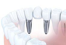 3D illustration of a bridge with dental implants