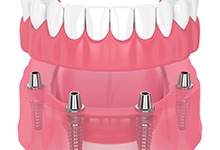 3D image of an implant denture 