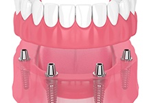 3D image of an implant denture 