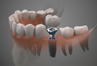 Single dental implant in San Antonio, TX placed in the jaw