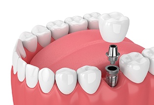 dental implant being placed in the lower jaw 