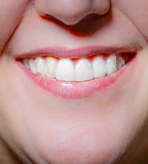 Close up of a woman's smile with Invisalign over the teeth