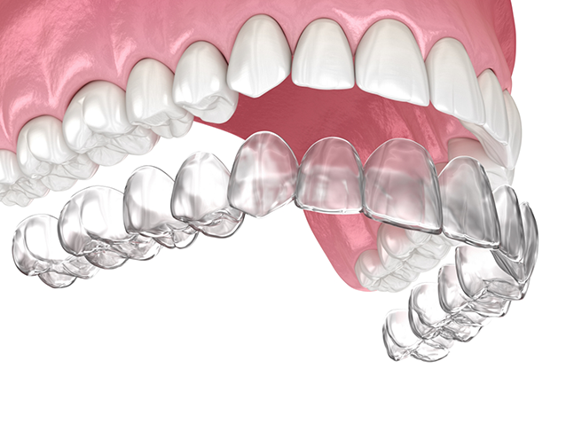 Illustration of an Invisalign aligner fitting over a row of teeth