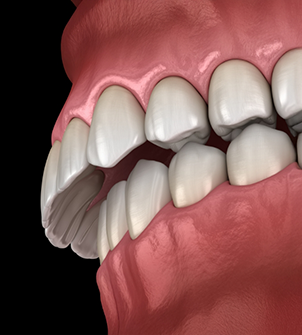 Illustrated mouth with an overbite