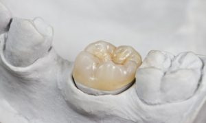 porcelain crown restoration set in bridge 