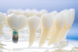 dental implant