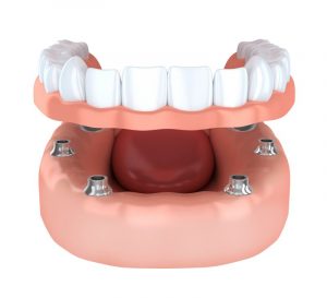 implant-retained dentures in San Antonio