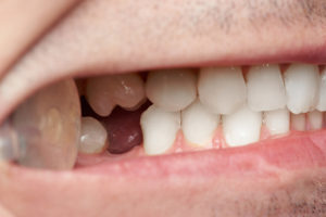 Teeth with gap of missing back tooth close-up